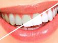 Хіти тижня. Лайфхак: Стоматолог розповів, як усунути зубний камінь і відбілити зуби за 4 хвилини
